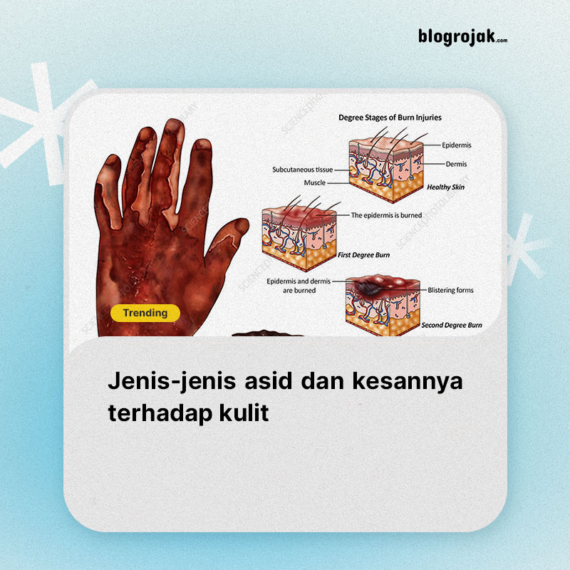 Jenis-Jenis Asid Dan Kesannya Terhadap Kulit